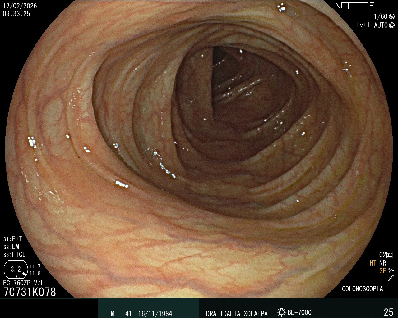 Colon Normal - Caso clínico Dra. Idalia Xolalpa Nieto