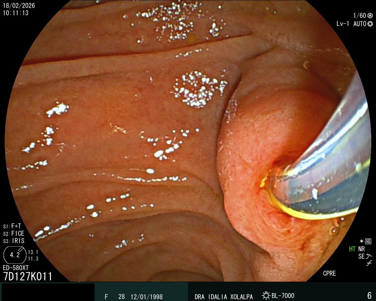 CPRE - Caso clínico Dra. Idalia Xolalpa Nieto