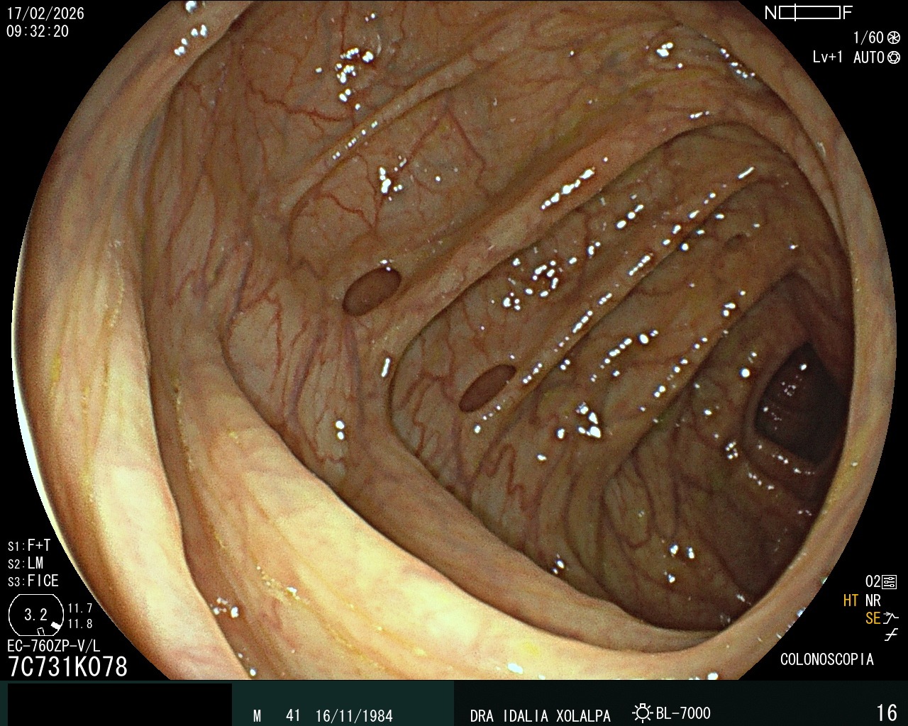 Divertículos - Caso clínico Dra. Idalia Xolalpa Nieto