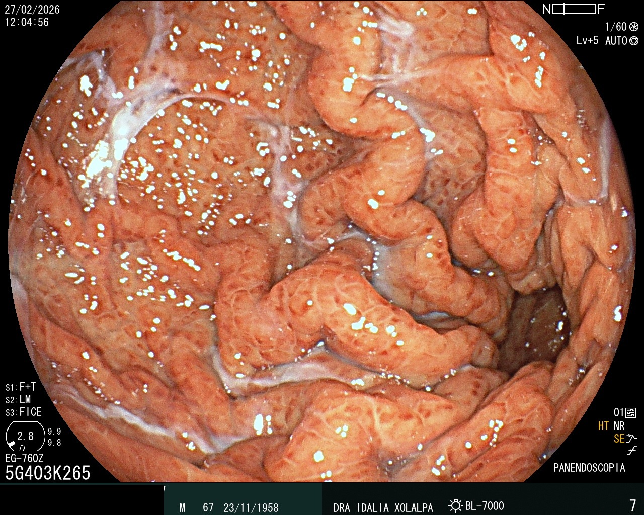 Gastritis Severa - Caso clínico Dra. Idalia Xolalpa Nieto