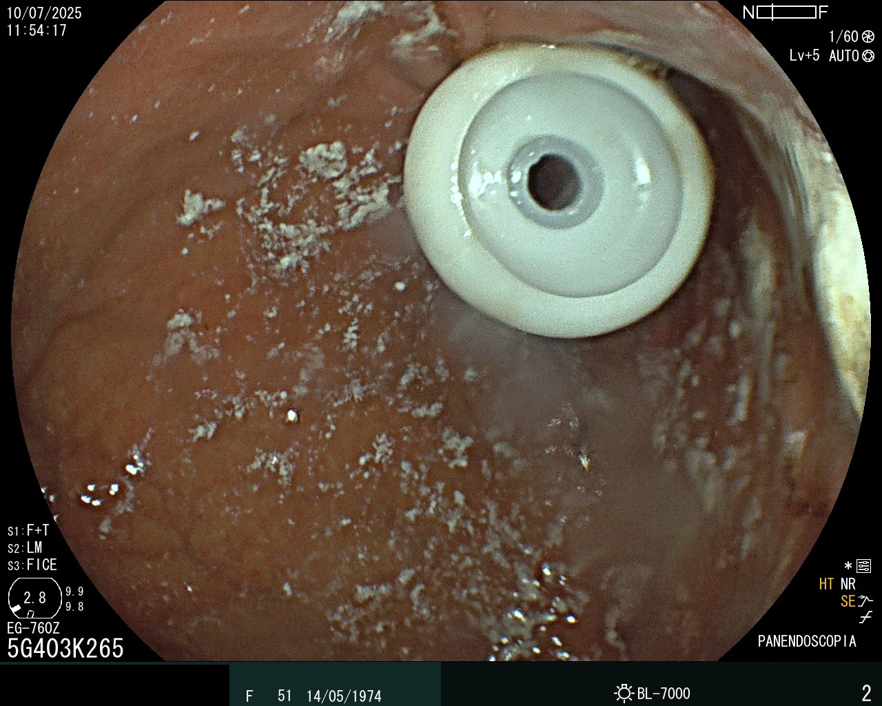 Gastrostomía - Caso clínico Dra. Idalia Xolalpa Nieto