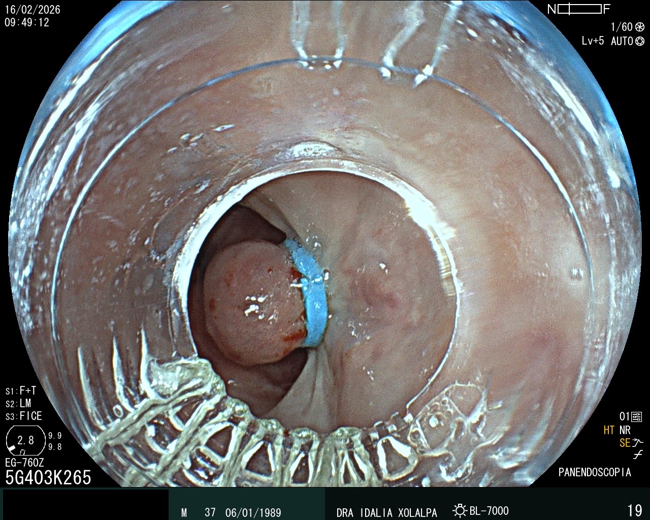 Ligadura de Várices - Caso clínico Dra. Idalia Xolalpa Nieto