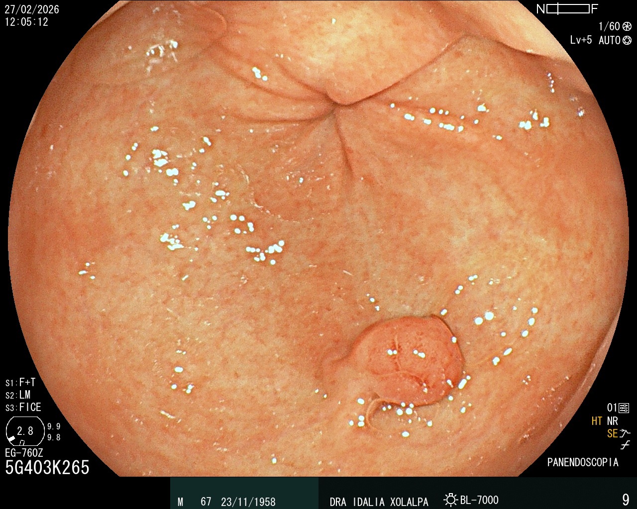 Pólipo en Antro - Caso clínico Dra. Idalia Xolalpa Nieto