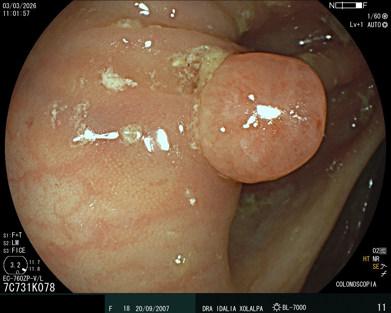 Pólipo en Colon - Caso clínico Dra. Idalia Xolalpa Nieto