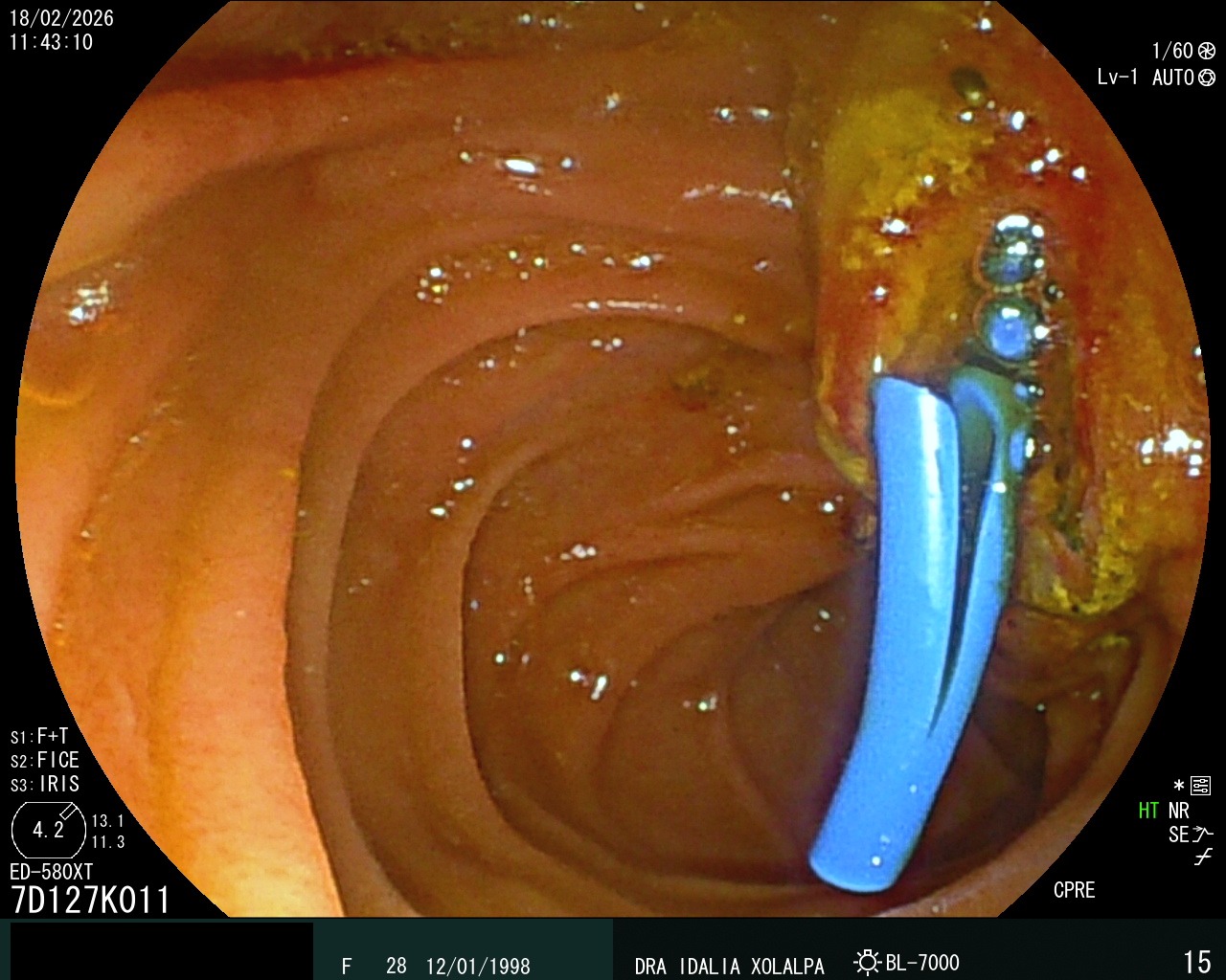 Prótesis Biliar - Caso clínico Dra. Idalia Xolalpa Nieto
