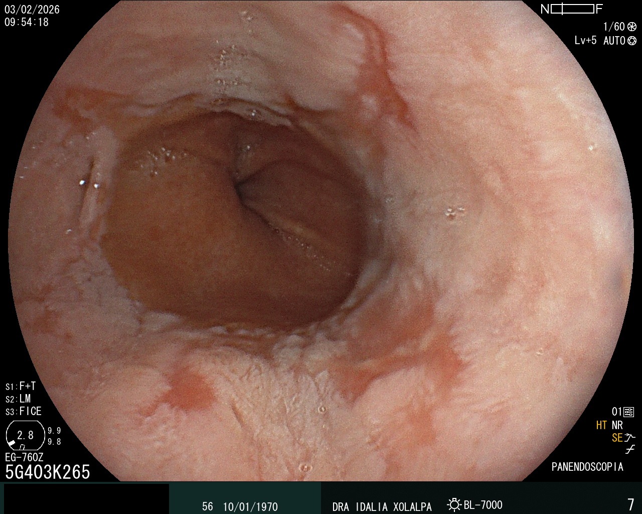 Reflujo Severo - Caso clínico Dra. Idalia Xolalpa Nieto