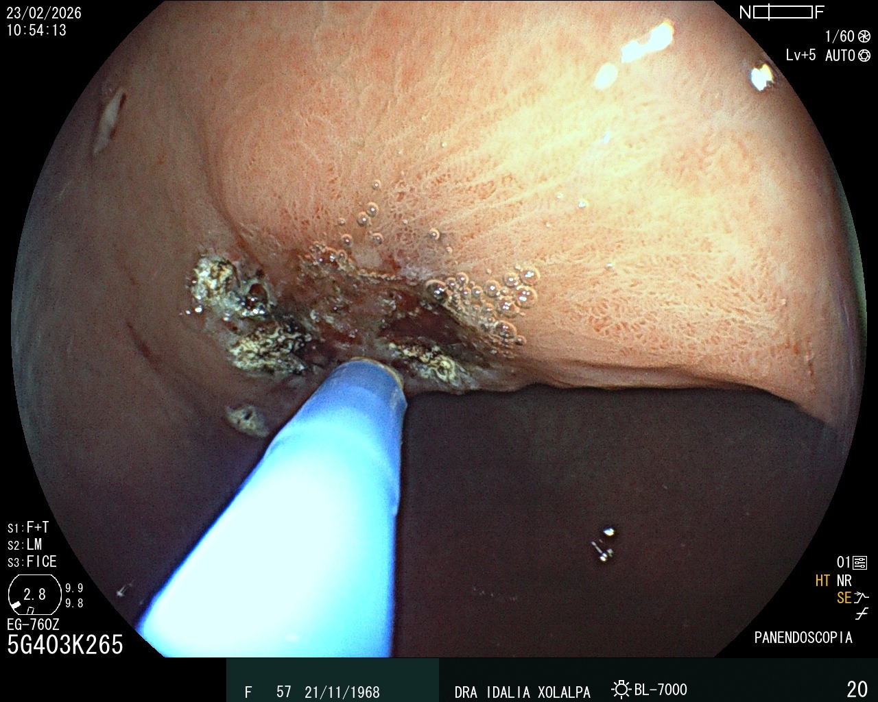 Terapia con Argón - Caso clínico Dra. Idalia Xolalpa Nieto