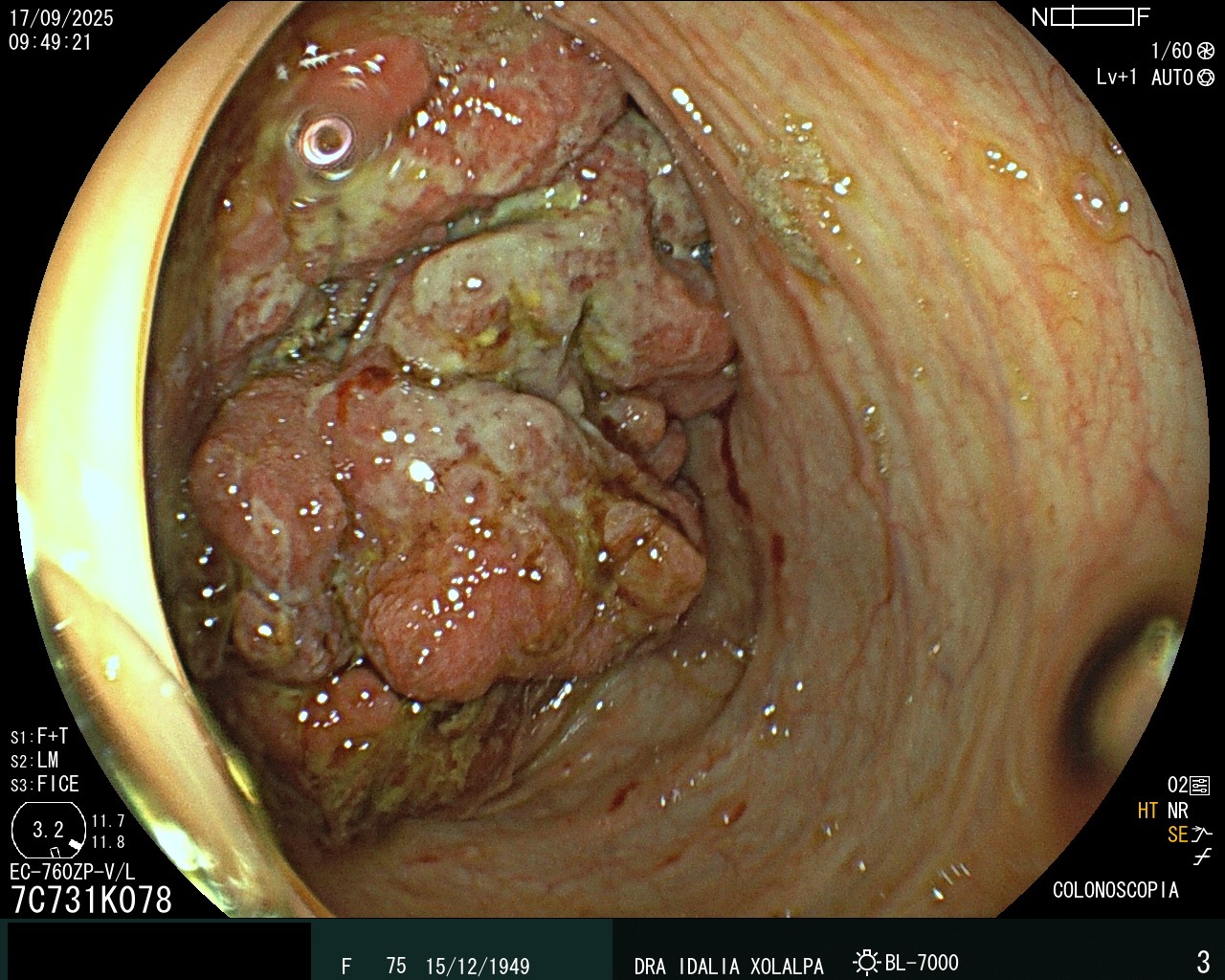 Detección de Tumores - Caso clínico Dra. Idalia Xolalpa Nieto