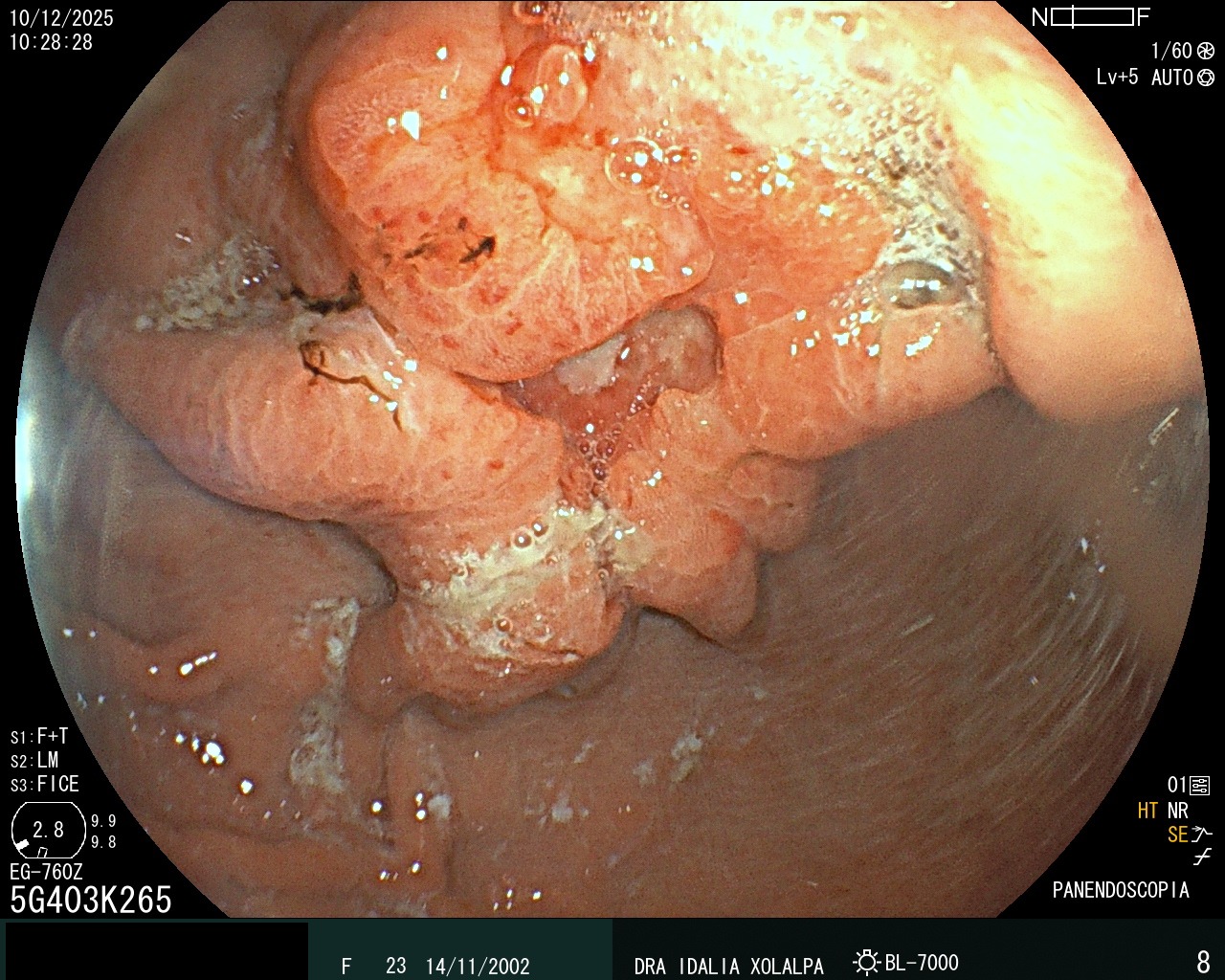 Tumor Gástrico - Caso clínico Dra. Idalia Xolalpa Nieto