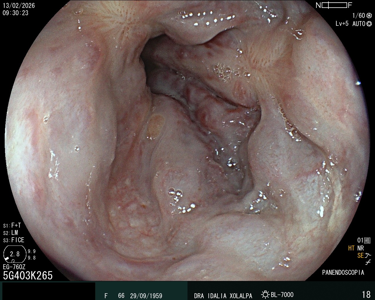 Várices Esofágicas - Caso clínico Dra. Idalia Xolalpa Nieto